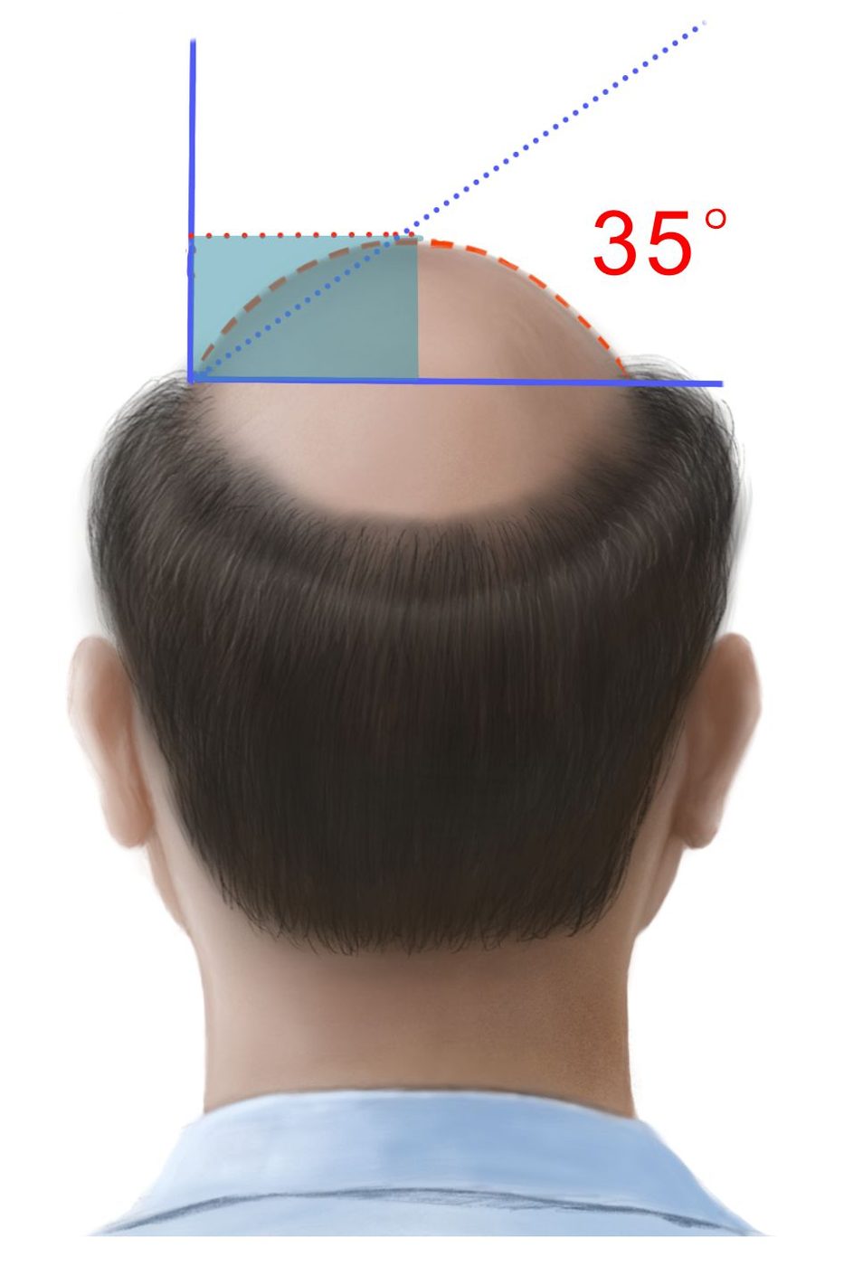 D 弧度 35°